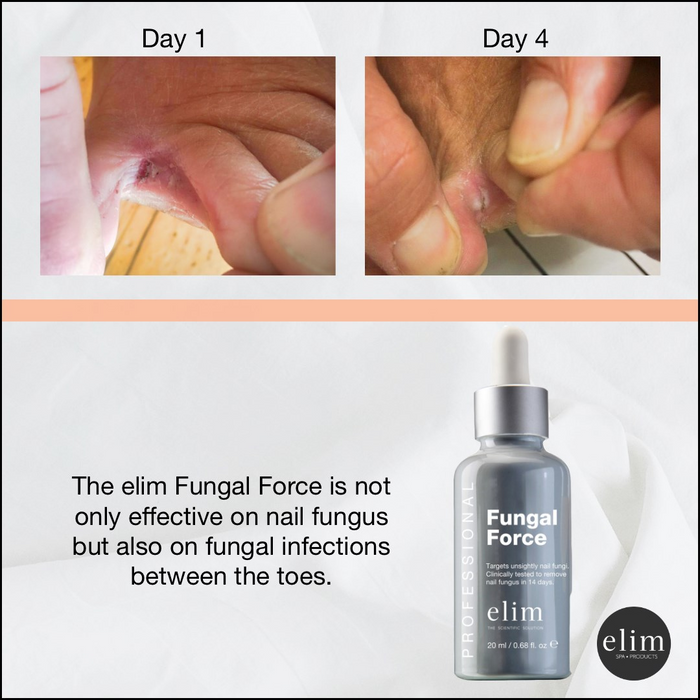 Elim  Fungal Force